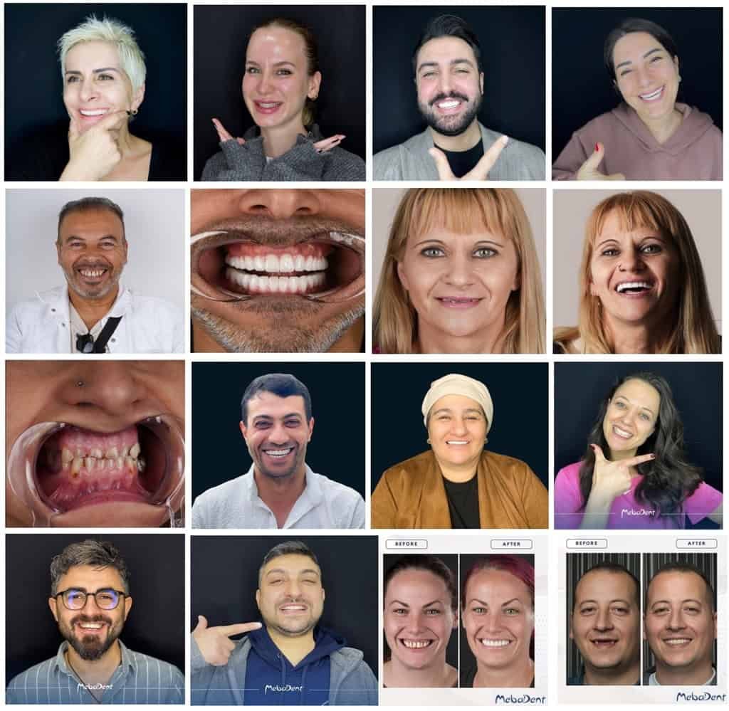 Full mouth and all-on-4/6 dental treatments in Turkey. Patient showcasing the results of all-on-4 and all-on-6 dental implant solutions at Mebadent Dental Clinic in Istanbul.